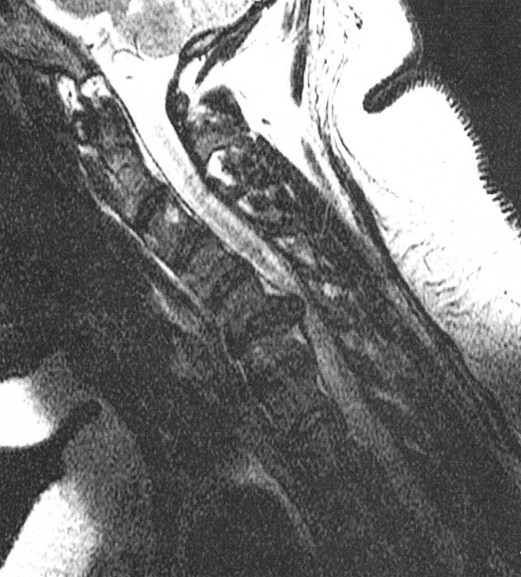 Classic C5-C6 cervical disc herniation MRI