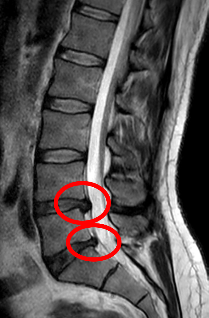 Classic L4-L5 lumbar disc herniation MRI