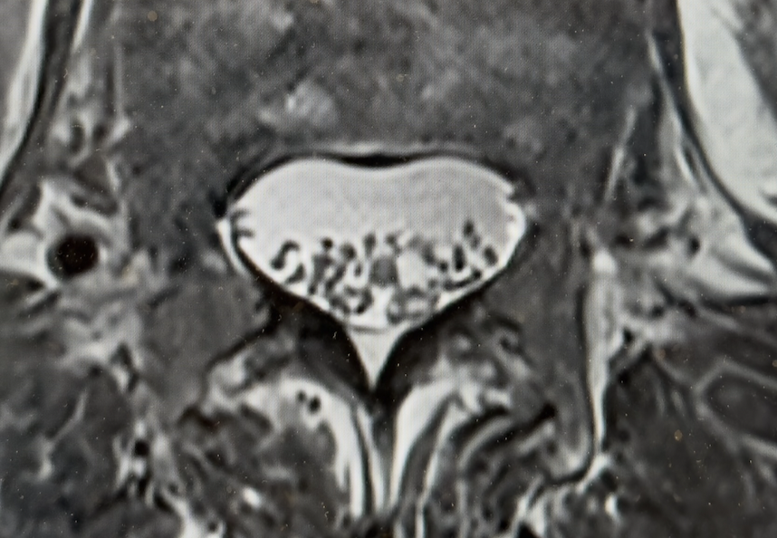 Axial lumbar spine MRI example