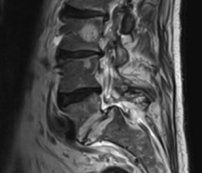 Sagittal lumbar spine MRI example