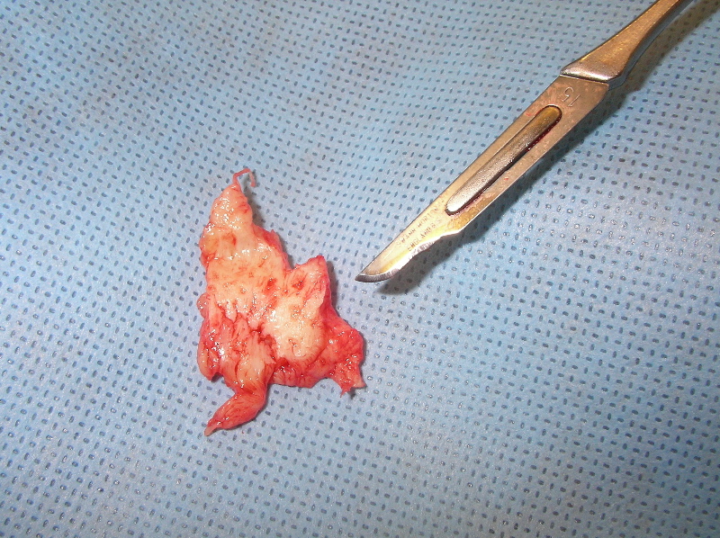 Removed L5/S1 disc fragment on surgical drape beside a scalpel